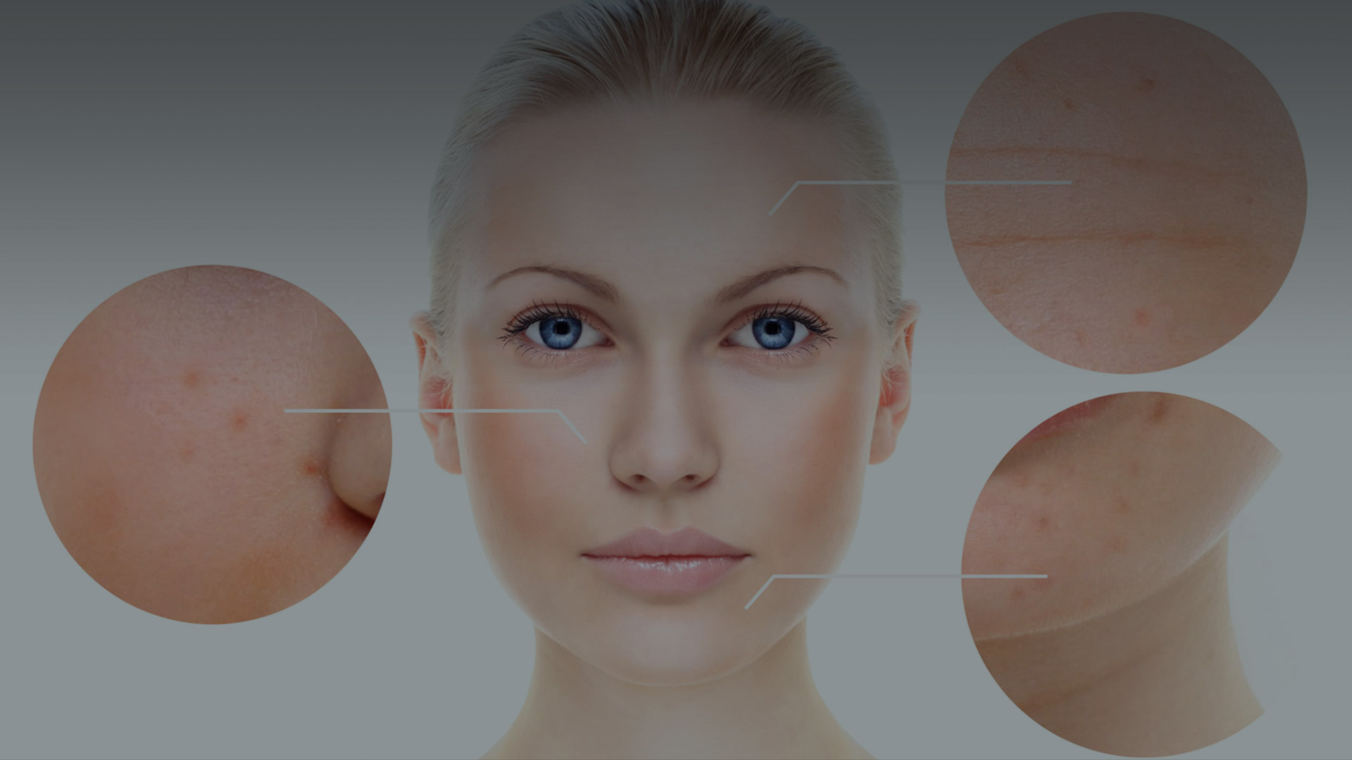 Acne and Acne Scars | Umhlanga & Ballito, Durban | Dr Ishaan Ramkisson
