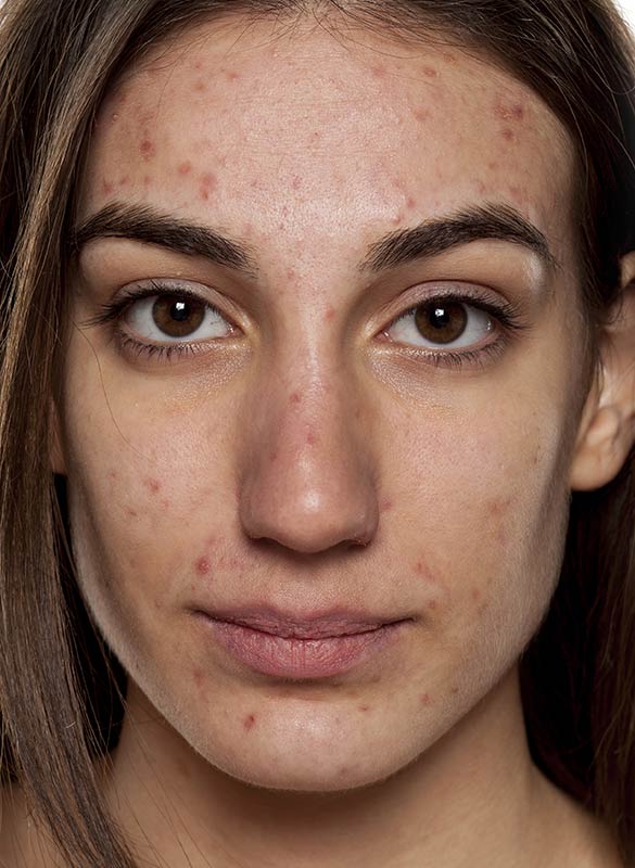 Acne And Acne Scars | Umhlanga & Ballito, Durban | Dr Ishaan Ramkisson