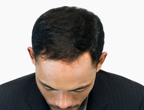Hair loss / Alopecia | Umhlanga & Ballito, Durban | Dr Ishaan Ramkisson