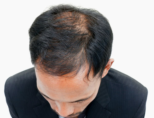Hair loss / Alopecia | Umhlanga & Ballito, Durban | Dr Ishaan Ramkisson